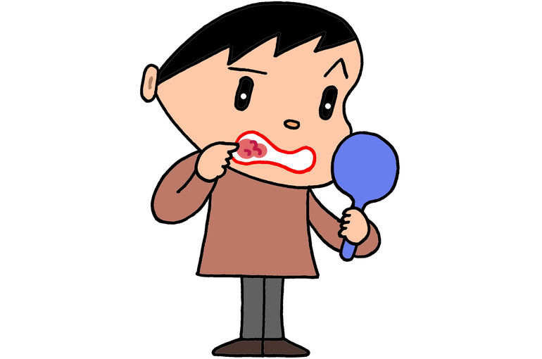 口内炎